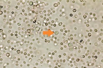 Conclusion: The detection of the increased expression of telomerase, C-MYC, CK19 and RRM1 indicates the presence of circulating cells in the examined blood sample, which would have to be interpreted as tumor cells.